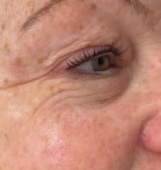 Before — HIFU Eyes