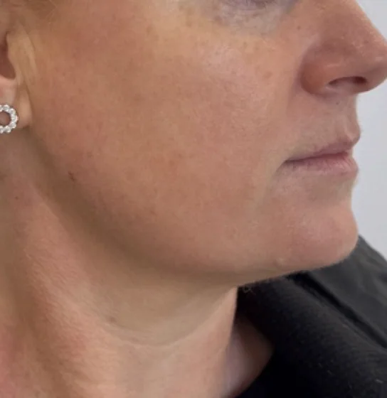After — HIFU Full Face & Neck