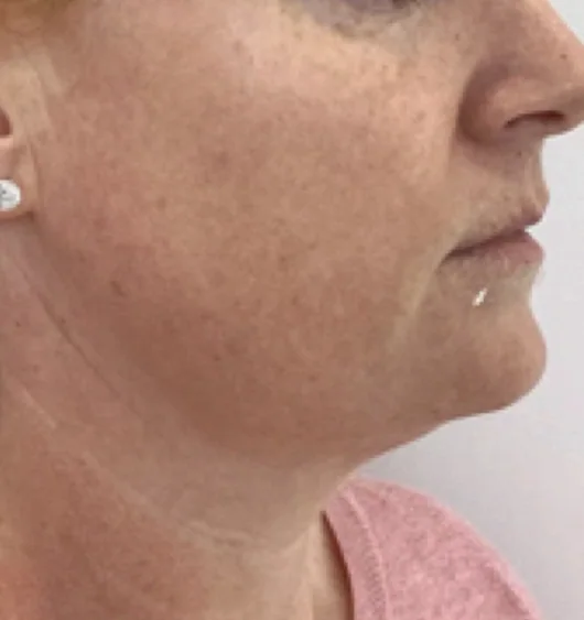 Before — HIFU Full Face & Neck