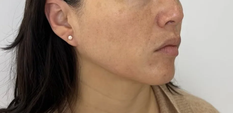 After — HIFU Full Face & Neck
