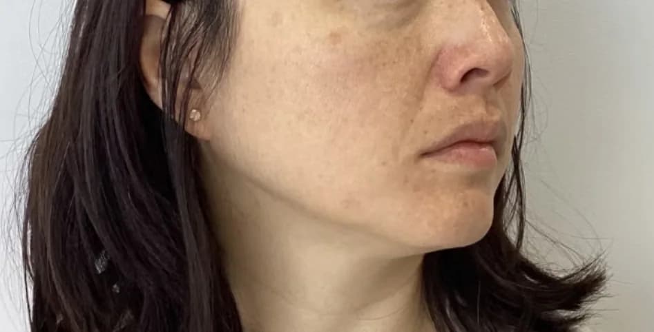 Before — HIFU Full Face & Neck