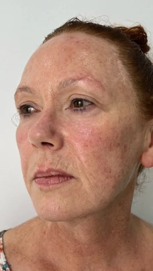 After — HIFU Full Face & Neck
