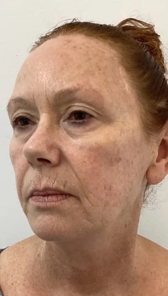 Before — HIFU Full Face & Neck
