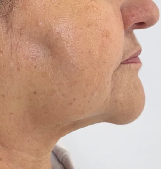 After — HIFU Full Face & Neck