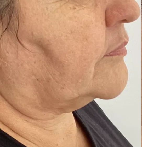 Before — HIFU Full Face & Neck
