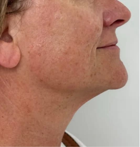 After — HIFU Full Face & Neck