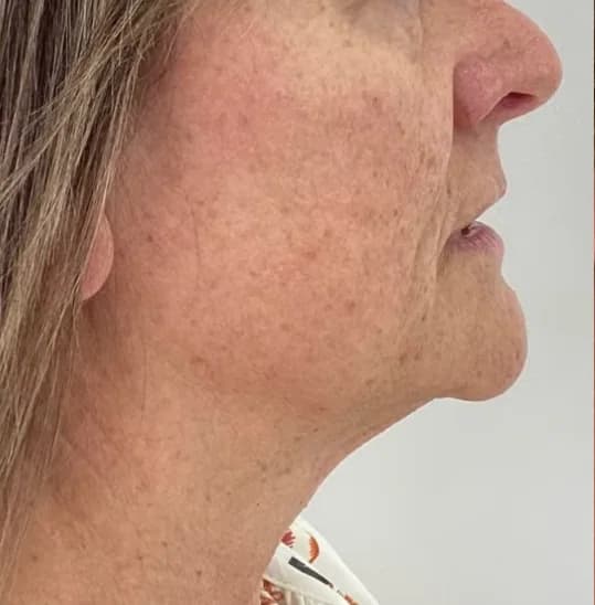 Before — HIFU Full Face & Neck
