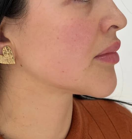 After — HIFU Face & Neck + RF Microneedling