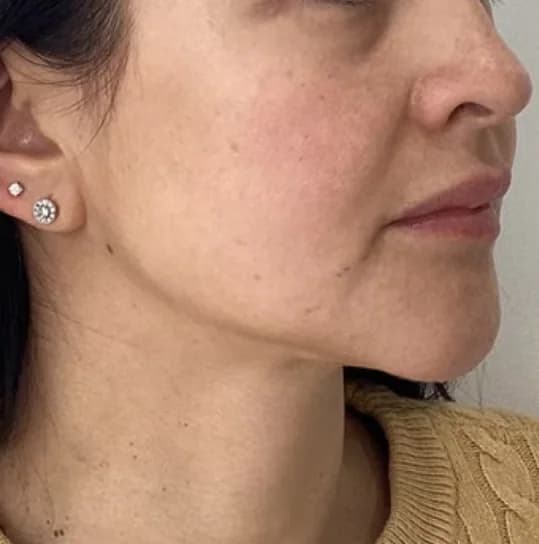 Before — HIFU Face & Neck + RF Microneedling