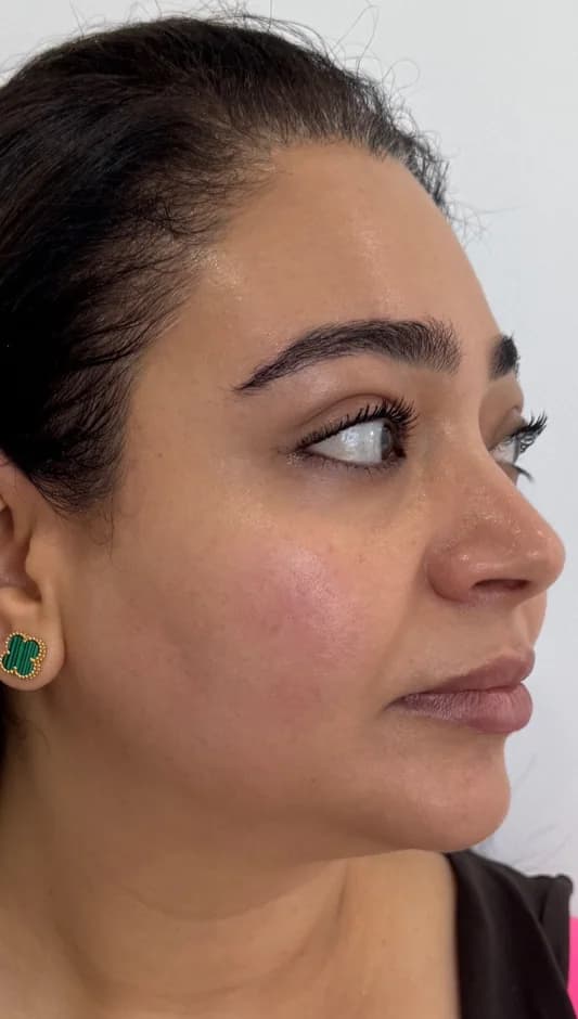 After — HIFU Full Face & Neck