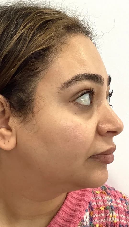 Before — HIFU Full Face & Neck
