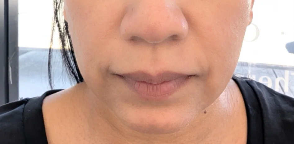 After — HIFU Full Face & Neck
