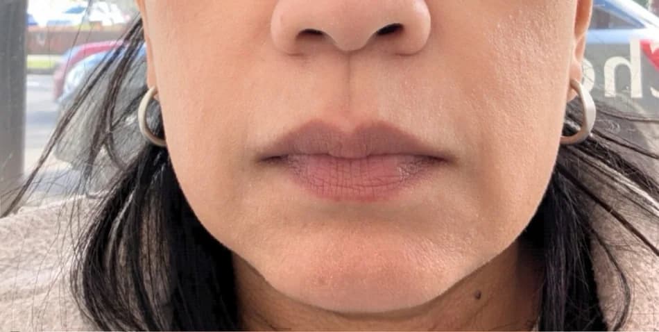 Before — HIFU Full Face & Neck