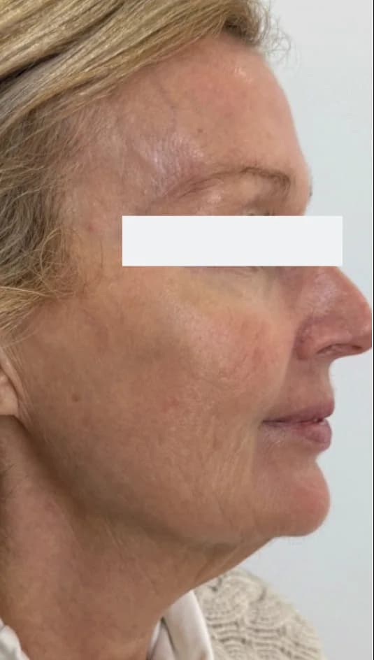 After — HIFU Full Face & Neck