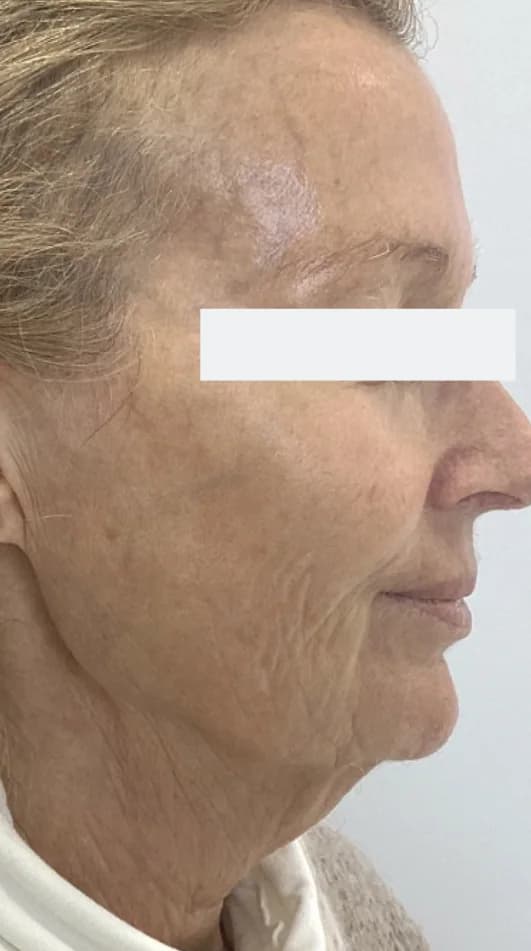 Before — HIFU Full Face & Neck