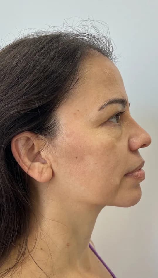 After — HIFU Full Face & Neck