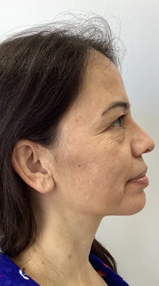 Before — HIFU Full Face & Neck