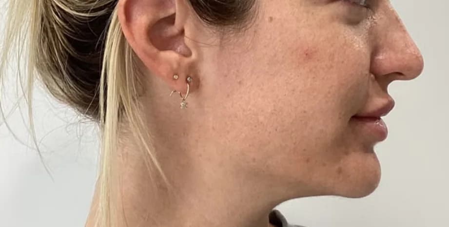 Before — HIFU Full Face & Neck