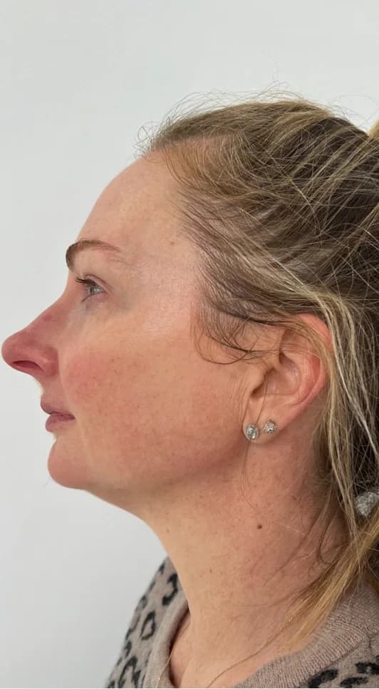 After — HIFU Full Face & Neck