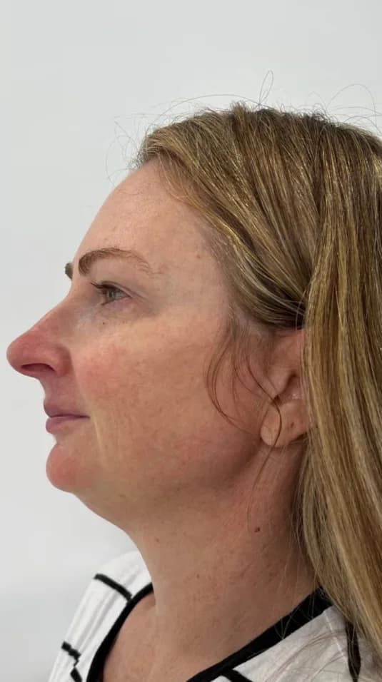 Before — HIFU Full Face & Neck