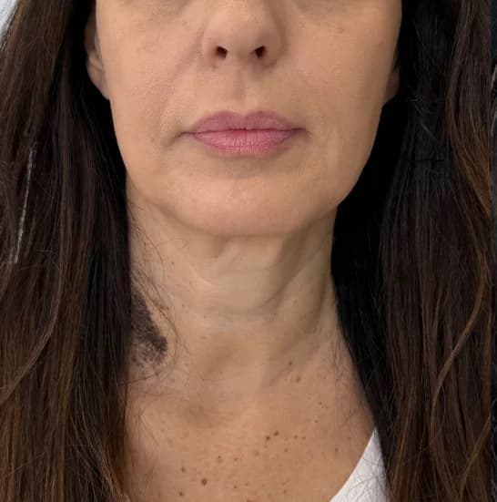 Before — HIFU Face & Neck + RF Microneedling