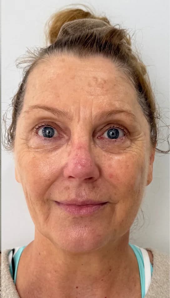 After — HIFU Full Face & Neck