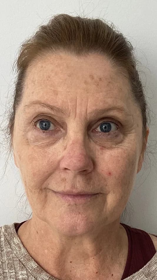 Before — HIFU Full Face & Neck