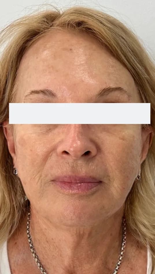 After — HIFU Full Face & Neck