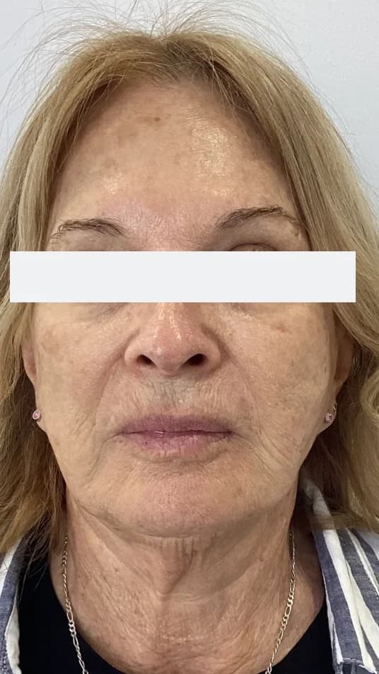 Before — HIFU Full Face & Neck
