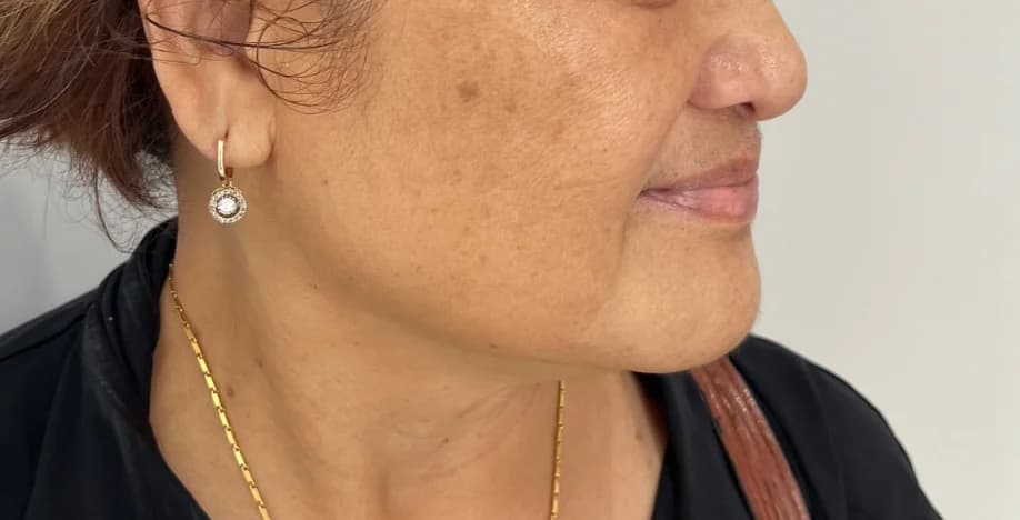 After — HIFU Full Face & Neck