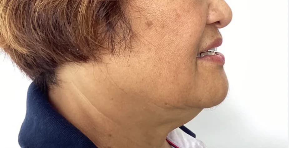 Before — HIFU Full Face & Neck