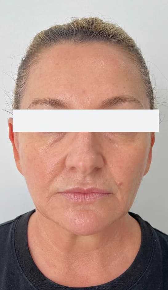 After — HIFU Full Face & Neck