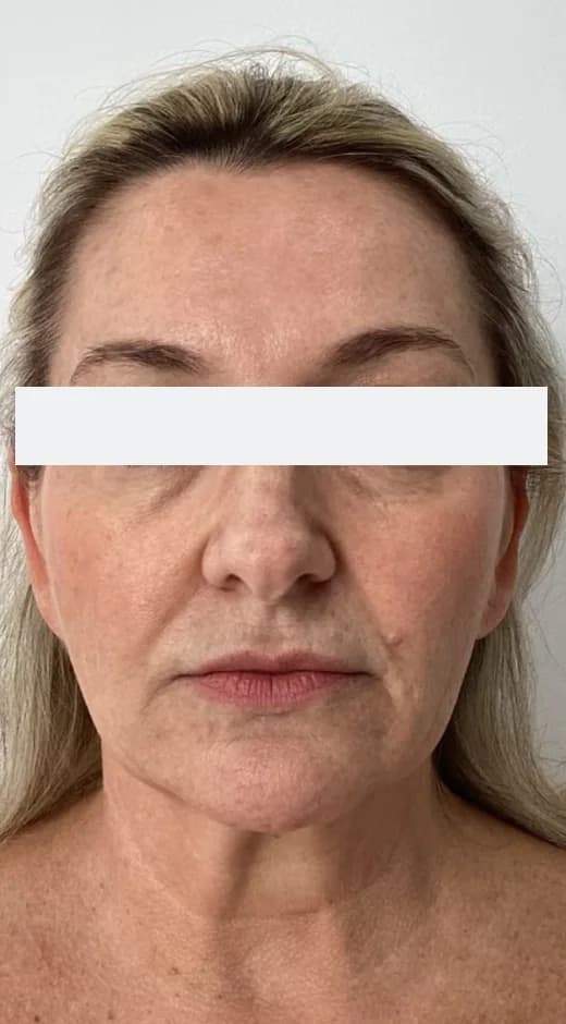 Before — HIFU Full Face & Neck