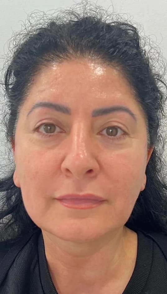 After — HIFU Face & Neck + RF Microneedling