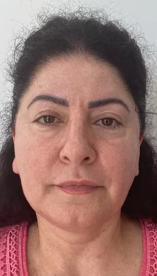 Before — HIFU Face & Neck + RF Microneedling