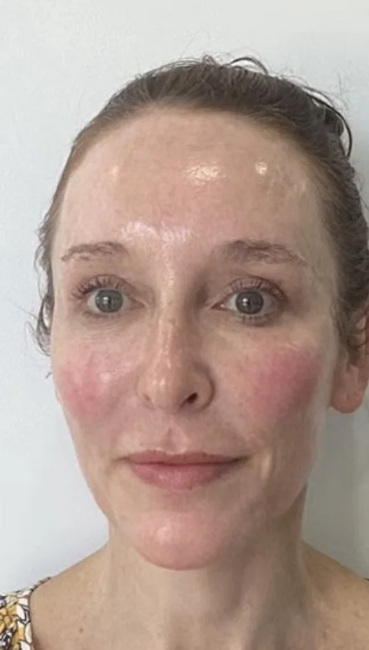 After — HIFU Full Face & Neck