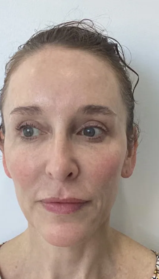 Before — HIFU Full Face & Neck