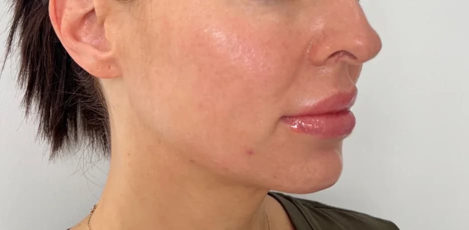 After — HIFU Full Face & Neck