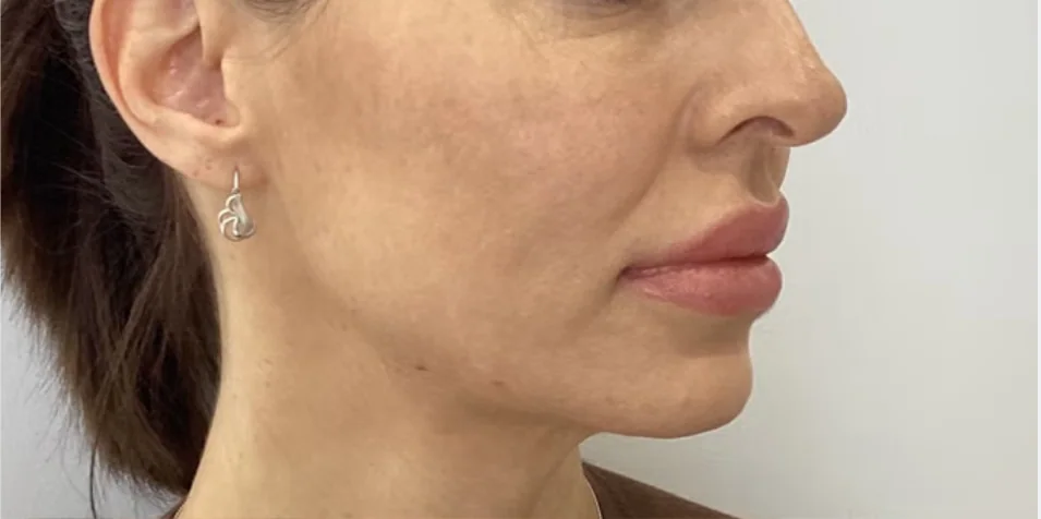 Before — HIFU Full Face & Neck
