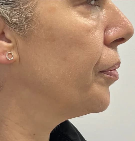 After — HIFU Full Face & Neck
