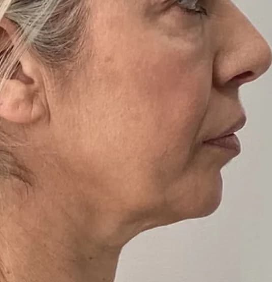 Before — HIFU Full Face & Neck