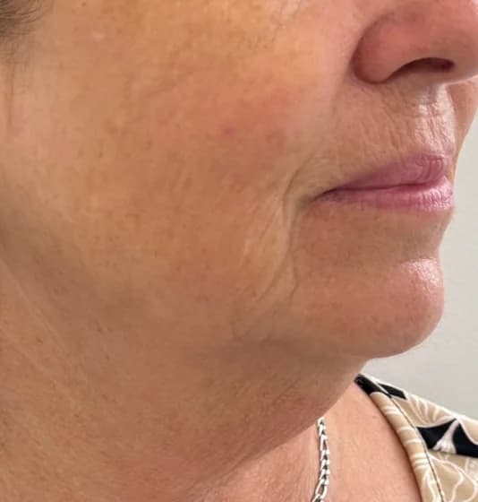 After — HIFU Full Face & Neck