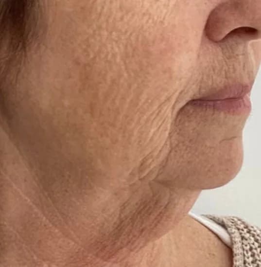 Before — HIFU Full Face & Neck