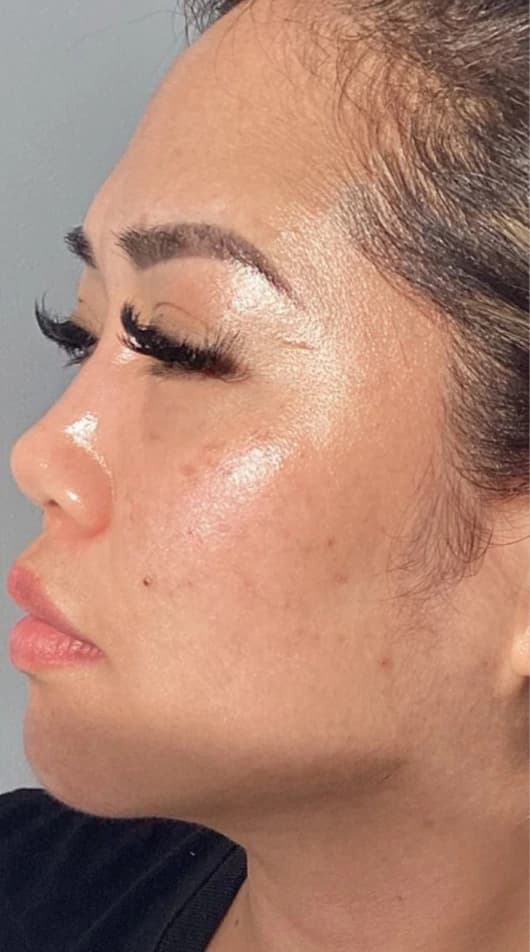 After — HIFU Full Face & Neck