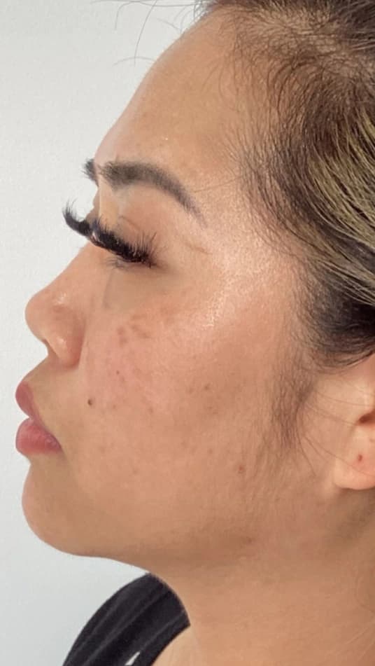 Before — HIFU Full Face & Neck