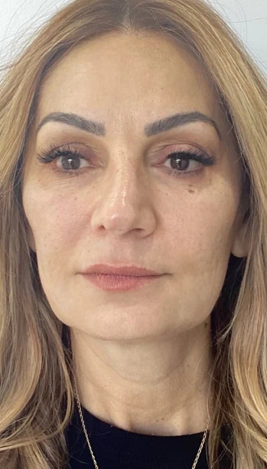After — HIFU Full Face & Neck