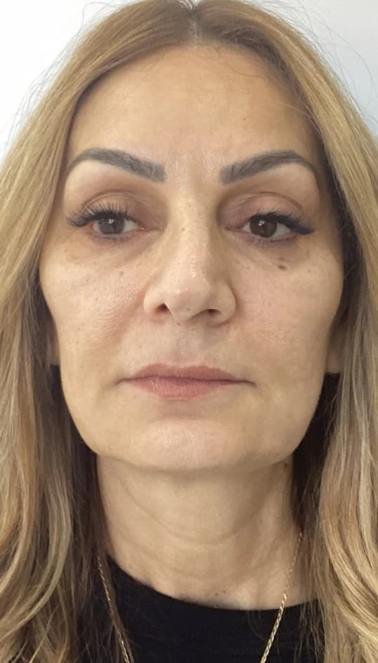 Before — HIFU Full Face & Neck