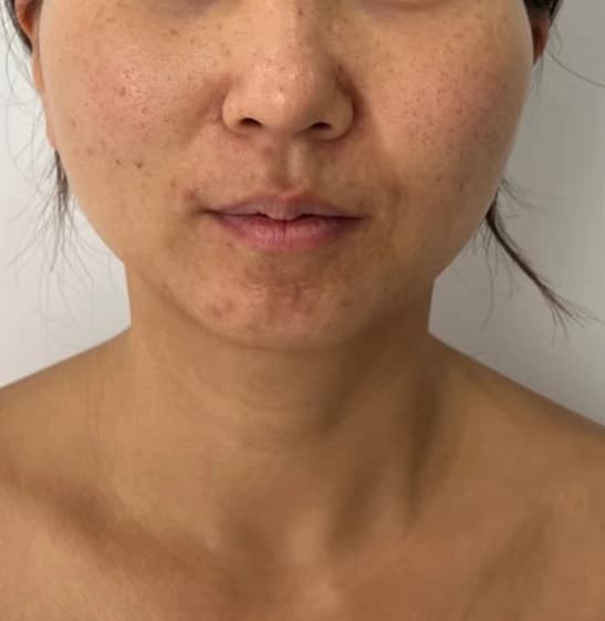Before — RF Microneedling