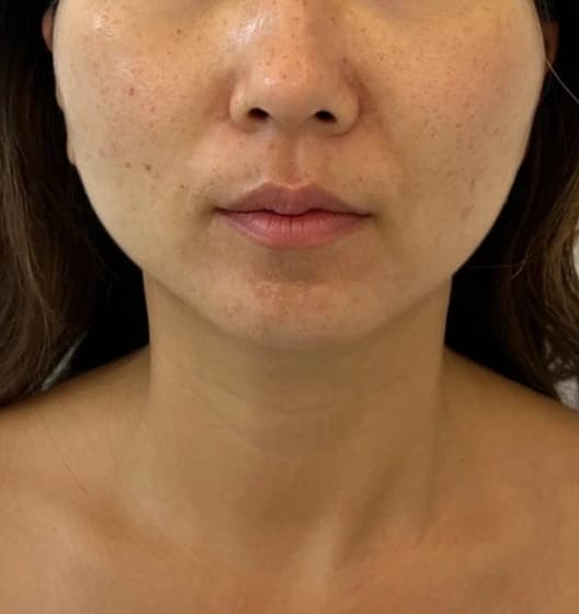 After — RF Microneedling