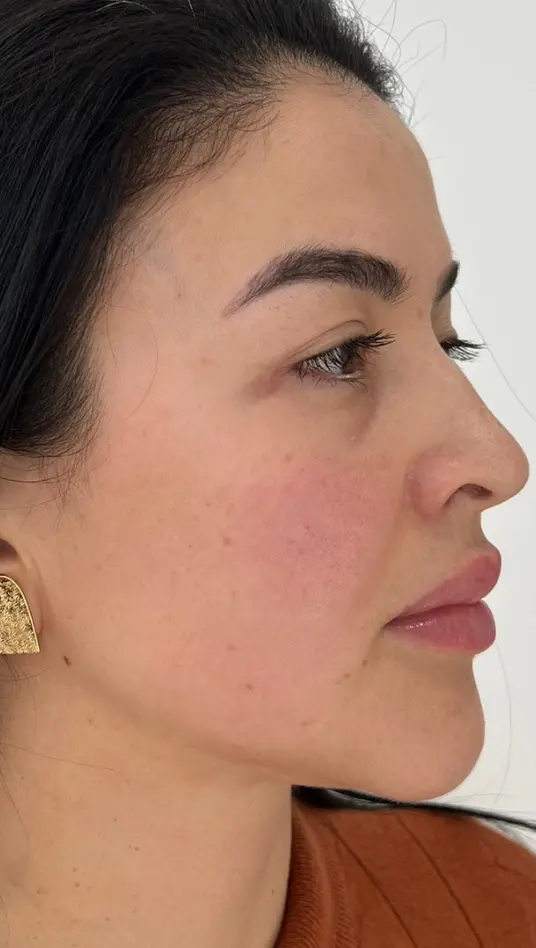 After — HIFU Full Face & Neck